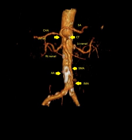 File:Celiacomesenteric trunk (Radiopaedia 67660-77083 VR arterial phase 2).jpg