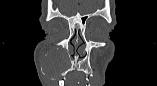 Central giant cell granuloma (Radiopaedia 83346-97761 Coronal bone window 6).jpg