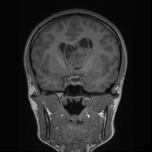 Central neurocytoma (Radiopaedia 37664-39557 Coronal T1 54).png