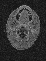 Central neurocytoma (Radiopaedia 56690-63469 Axial T1 C+ 176).jpg