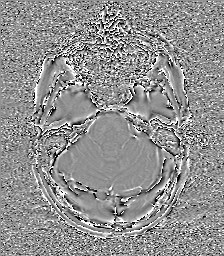 Central neurocytoma (Radiopaedia 84497-99872 Axial 19).jpg