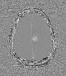Central neurocytoma (Radiopaedia 84497-99872 Axial 53).jpg