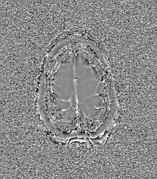 Central neurocytoma (Radiopaedia 84497-99872 Axial 65).jpg