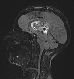 File:Central neurocytoma (Radiopaedia 84497-99872 Sagittal Flair + Gd 76).jpg