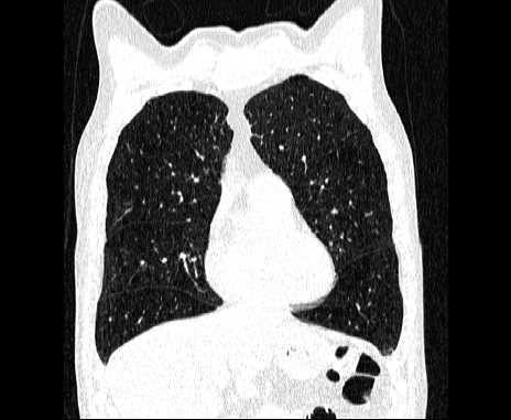 Centrilobular pulmonary emphysema (Radiopaedia 62468-70718 Coronal lung window 21).jpg