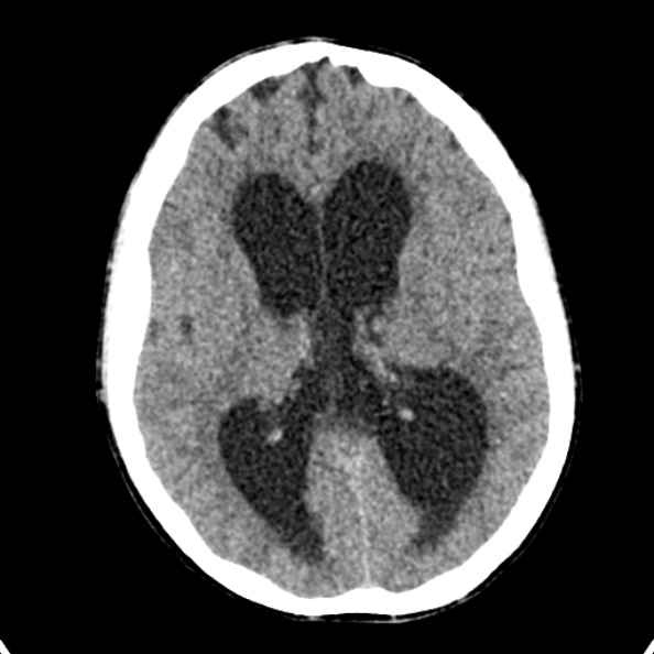 Cerebellar abscess secondary to mastoiditis (Radiopaedia 26284-26412 Axial non-contrast 86).jpg