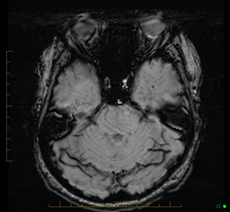 Cerebellar gangliocytoma (Radiopaedia 65377-74422 Axial SWI 17).jpg