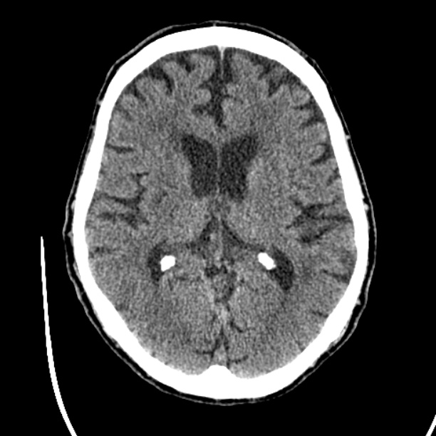 Cerebellar hemorrhage (Radiopaedia 27193-27359 Axial non-contrast 27).jpg