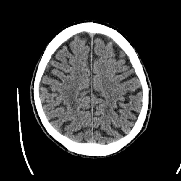 Cerebellar hemorrhage (Radiopaedia 27193-27359 Axial non-contrast 40).jpg