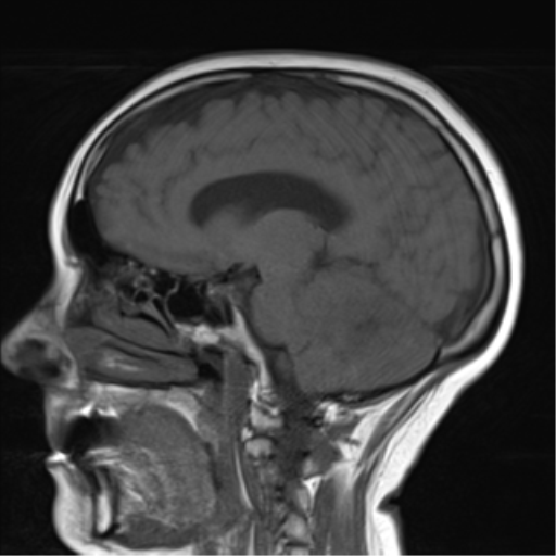 File:Cerebellar metastasis (Radiopaedia 54578-60810 Sagittal T1 9).png