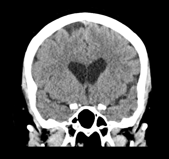 File:Cerebellar metastasis (Radiopaedia 54578-60812 Coronal non-contrast 21).png