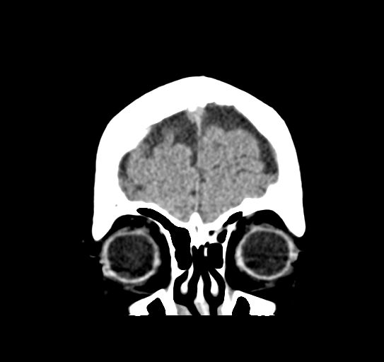 Cerebellar metastasis (Radiopaedia 54578-60812 Coronal non-contrast 6).png