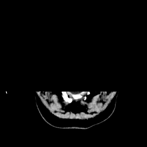 Cerebellar metastasis (cystic appearance) (Radiopaedia 41395-44258 Axial non-contrast 4).png