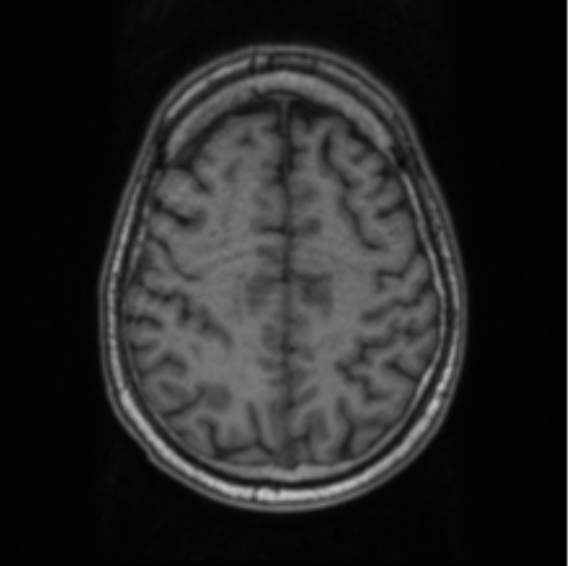 Cerebellar metastasis from lung adenocarcinoma (Radiopaedia 86690-102829 Axial T1 62).png