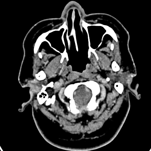 Cerebellopontine angle meningioma (Radiopaedia 35181-36714 A 57).jpg