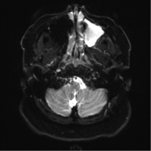 Cerebellopontine angle meningioma (Radiopaedia 48434-53348 Axial DWI 4).png