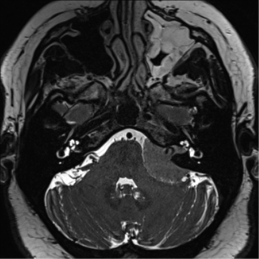Cerebellopontine angle meningioma (Radiopaedia 48434-53348 Axial T2 Space 52).png