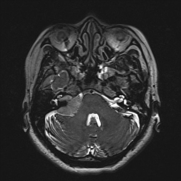 File:Cerebellopontine angle meningioma (Radiopaedia 53561-59591 Axial 3D volume T2 57).jpg