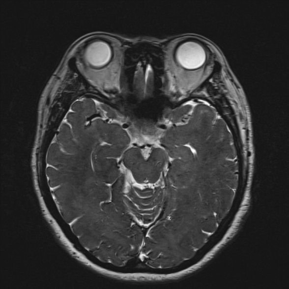 File:Cerebellopontine angle meningioma (Radiopaedia 53561-59591 Axial 3D volume T2 98).jpg
