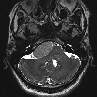 Cerebellopontine angle meningioma (Radiopaedia 72983-83680 Axial FIESTA 22).jpg