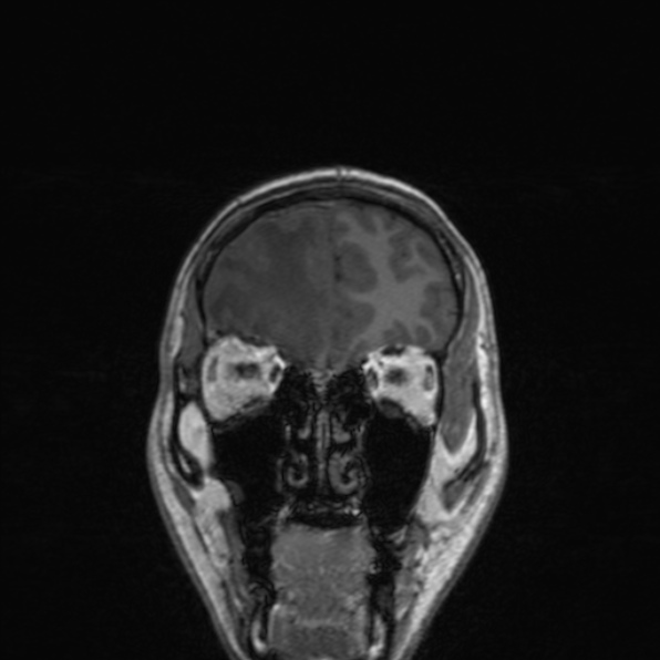 Cerebral abscess (Radiopaedia 24212-24478 Coronal T1 53).jpg
