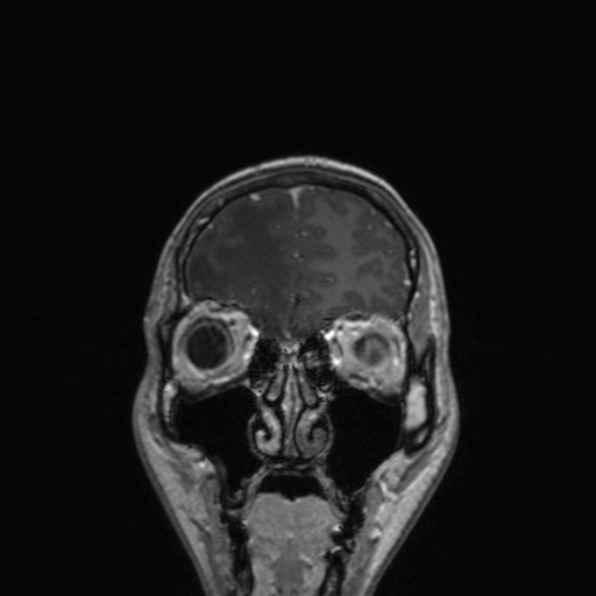Cerebral abscess (Radiopaedia 24212-24478 Coronal T1 C+ 49).jpg