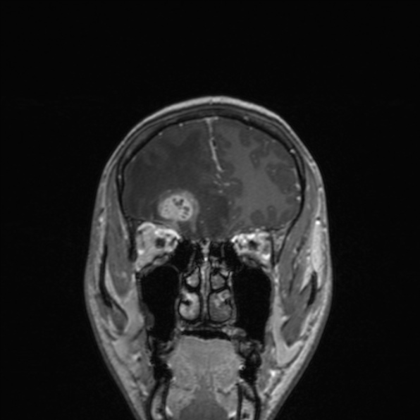 Cerebral abscess (Radiopaedia 24212-24478 Coronal T1 C+ 60).jpg