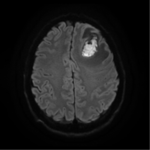 File:Cerebral abscess (Radiopaedia 57774-64740 Axial DWI 21).png