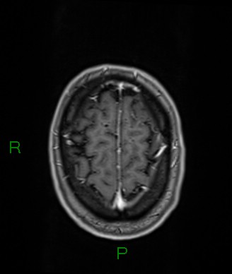 File:Cerebral abscess and subdural empyema (Radiopaedia 84436-99779 Axial T1 C+ 16).jpg