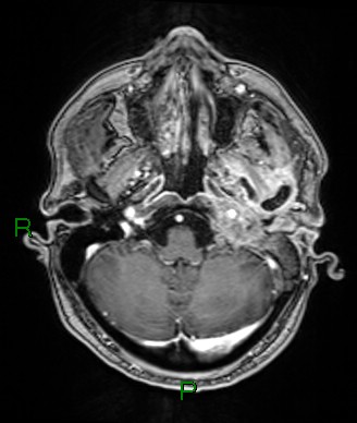 Cerebral abscess and subdural empyema (Radiopaedia 84436-99779 Axial T1 C+ 69).jpg