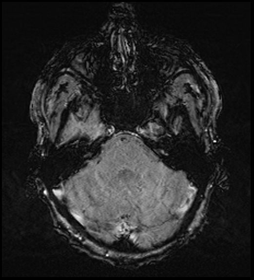 Cerebral abscess with ventriculitis (Radiopaedia 78965-91878 Axial SWI 16).jpg