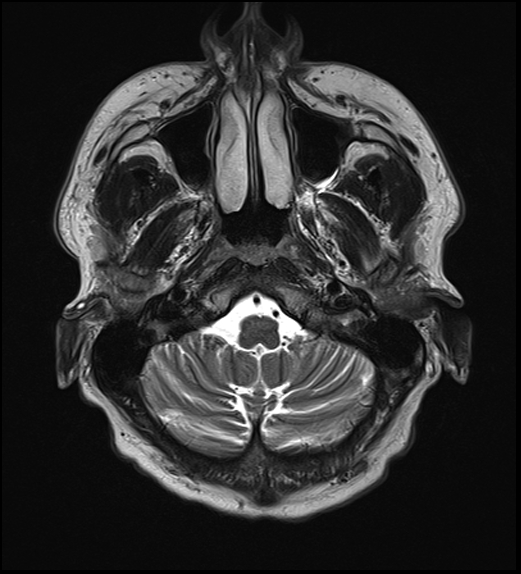 File:Cerebral abscess with ventriculitis (Radiopaedia 78965-91878 Axial T2 7).jpg