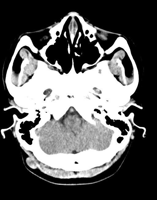 Cerebral abscesses (Radiopaedia 70458-80568 Axial non-contrast 15).jpg