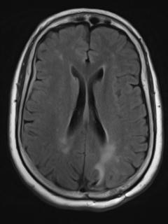 File:Cerebral amyloid angiopathy (Radiopaedia 29129-29518 Axial FLAIR 13).jpg
