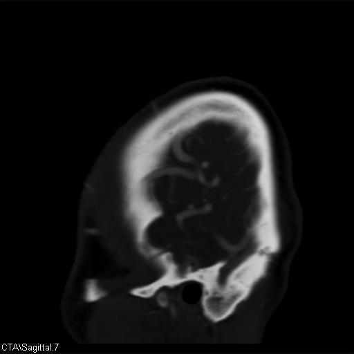 File:Cerebral arteriovenous malformation (Radiopaedia 28518-28759 D 4).jpg