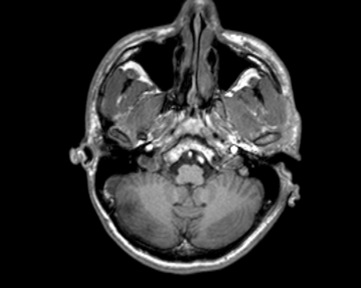 Cerebral arteriovenous malformation (Radiopaedia 30198-30813 Axial T1 47).jpg