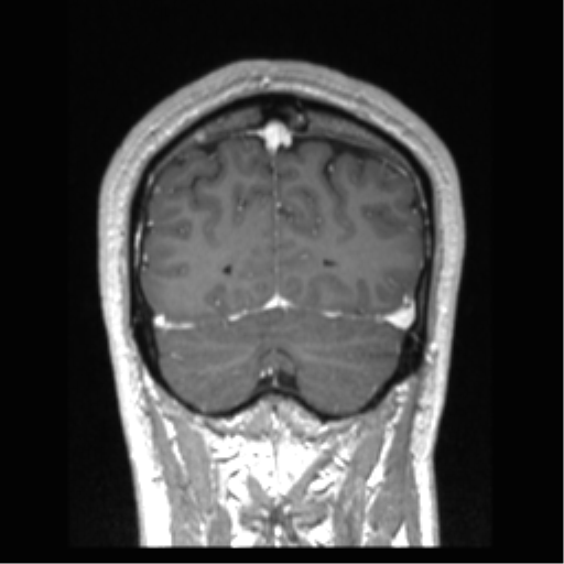 Cerebral arteriovenous malformation (Radiopaedia 39259-41506 Coronal T1 C+ 20).png