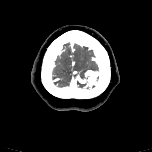 Cerebral arteriovenous malformation (Radiopaedia 73830-84645 Axial C+ delayed 5).jpg