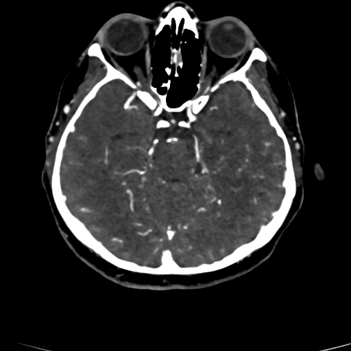 Cerebral arteriovenous malformation (Radiopaedia 73830-84645 Axial C+ delayed 60).jpg