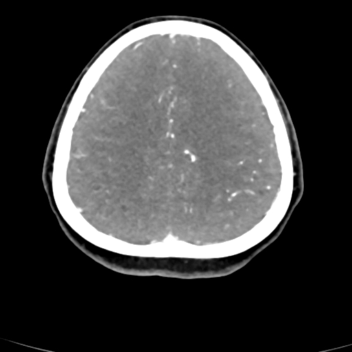File:Cerebral arteriovenous malformation (Radiopaedia 73830-84645 B 25).jpg