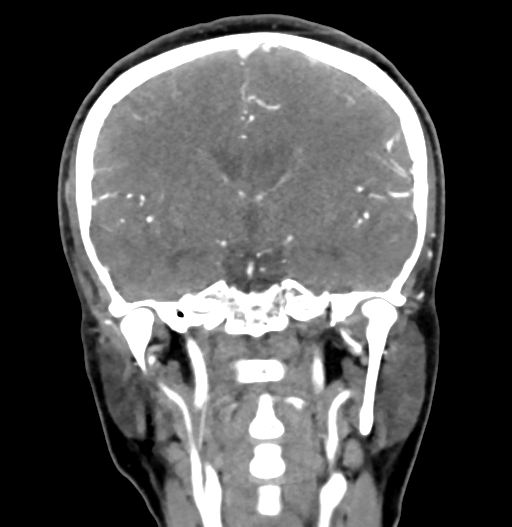 Cerebral arteriovenous malformation (Radiopaedia 73830-84645 C 50).jpg