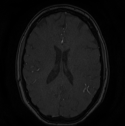 Cerebral arteriovenous malformation (Radiopaedia 74411-85654 Axial MRA 95).jpg