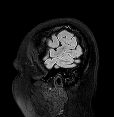 File:Cerebral arteriovenous malformation (Radiopaedia 74411-85746 Sagittal FLAIR 6).jpg