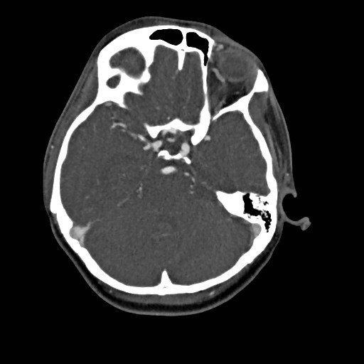 File:Cerebral arteriovenous malformation (Radiopaedia 79677-92888 A 14).jpg