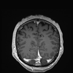 Cerebral arteriovenous malformation (Radiopaedia 84015-99245 Coronal T1 C+ 133).jpg