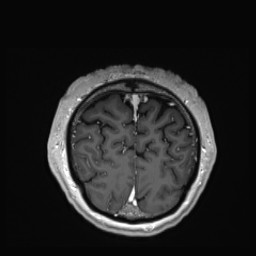 Cerebral arteriovenous malformation (Radiopaedia 84015-99245 Coronal T1 C+ 150).jpg