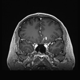 Cerebral arteriovenous malformation (Radiopaedia 84015-99245 Coronal T1 C+ 55).jpg