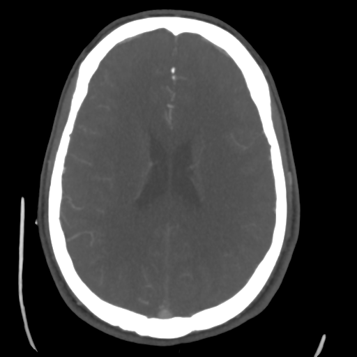 Cerebral arteriovenous malformation (Spetzler-Martin grade 2) (Radiopaedia 41262-44076 E 34).png
