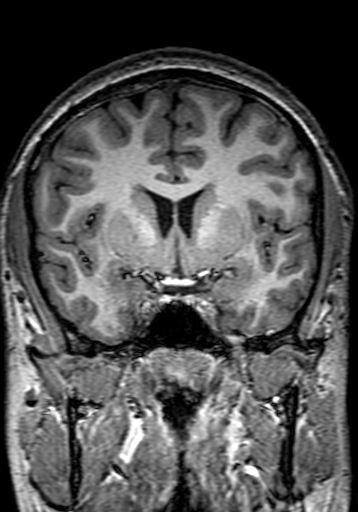 Cerebral arteriovenous malformation at posterior body of corpus callosum (Radiopaedia 74111-84925 Coronal T1 127).jpg