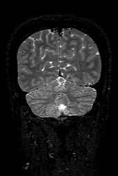 Cerebral arteriovenous malformation at posterior body of corpus callosum (Radiopaedia 74111-84925 Coronal T2 146).jpg
